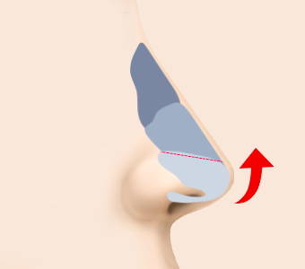코끝 하외측 연골을 위쪽으로 올려 봉합하는 과정