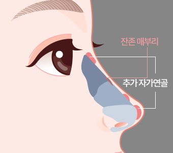 코끝과 코끝 바로 위, 미간에 자가연골을 삽입하는 과정