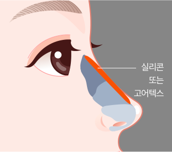 콧대부분 실리콘 삽입하는 과정