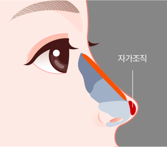 코끝 부분 자가조직 삽입하는 모습