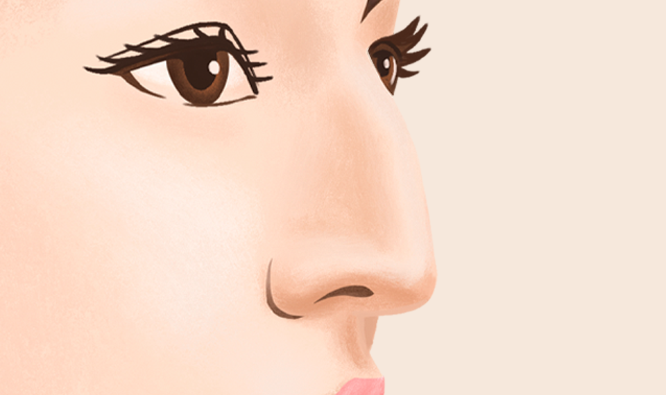 매부리 교정이 덜 된 경우 before