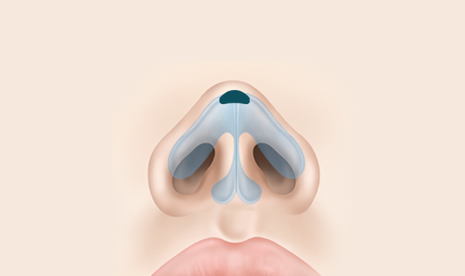  좌우 콧날개의 비대칭이 있는 경우 after