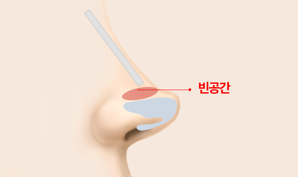 보형물의 코 끝부분 디자인 처리가 잘못되어 빈 공간이 생긴 경우