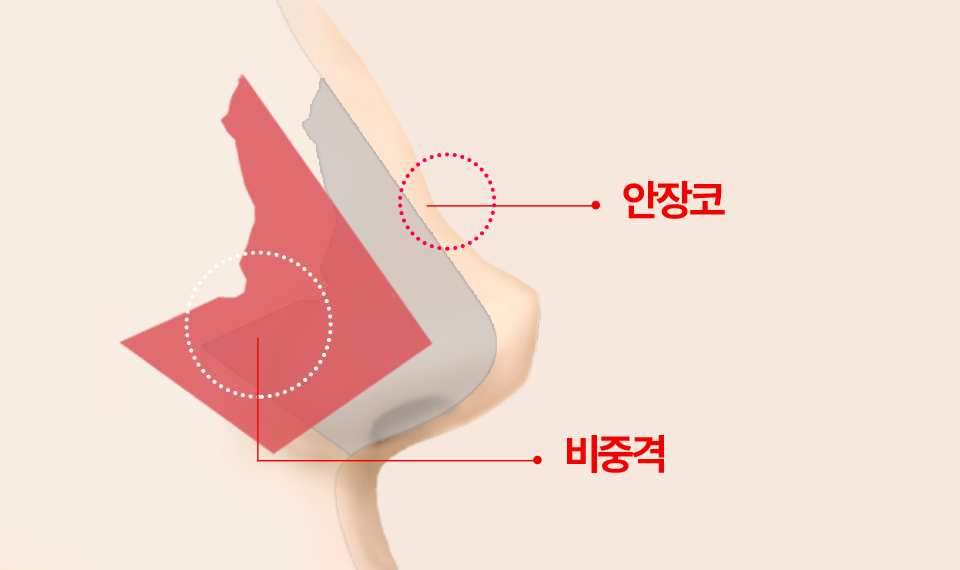 비중격의 지지력이 약해져 안장코의 형태가 된 경우