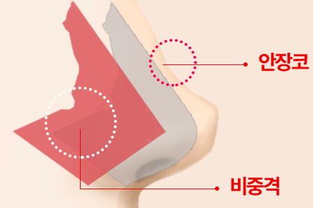 무너진 콧등 라인을 재건