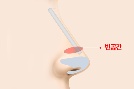 새 보형물로 코 내부 구조에 맞춰 교체