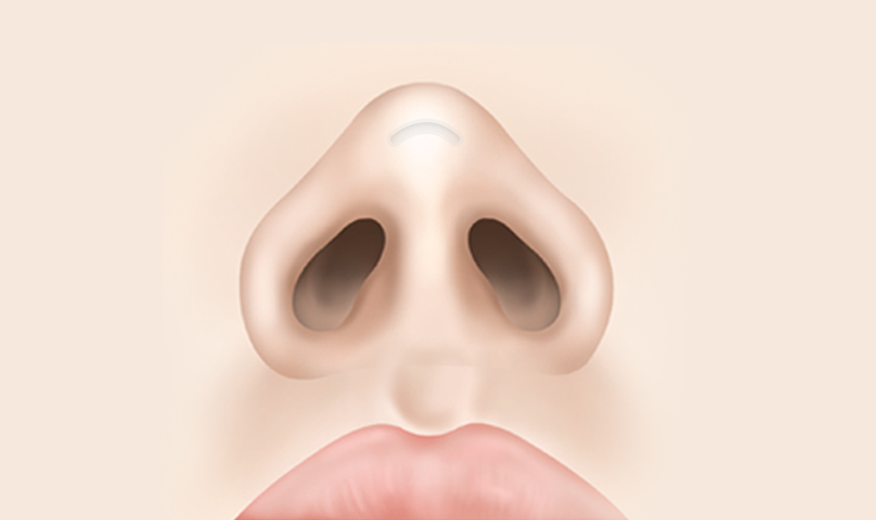 피부조직이 약해져 보형물이 비치거나 피부 밖으로 튀어나온 경우
